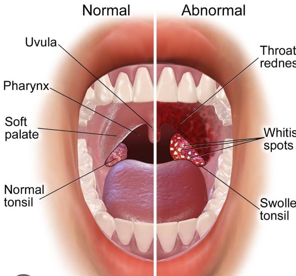 throat infection